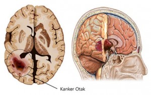 Obat Herbal Kanker Otak